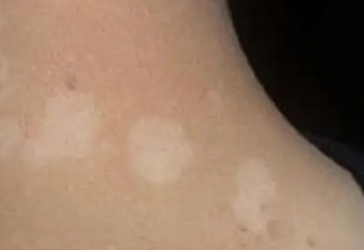 微量元素測定儀解讀微量元素缺乏引起白斑的影響 微量元素測定儀解讀微量元素缺乏引起白斑的影響